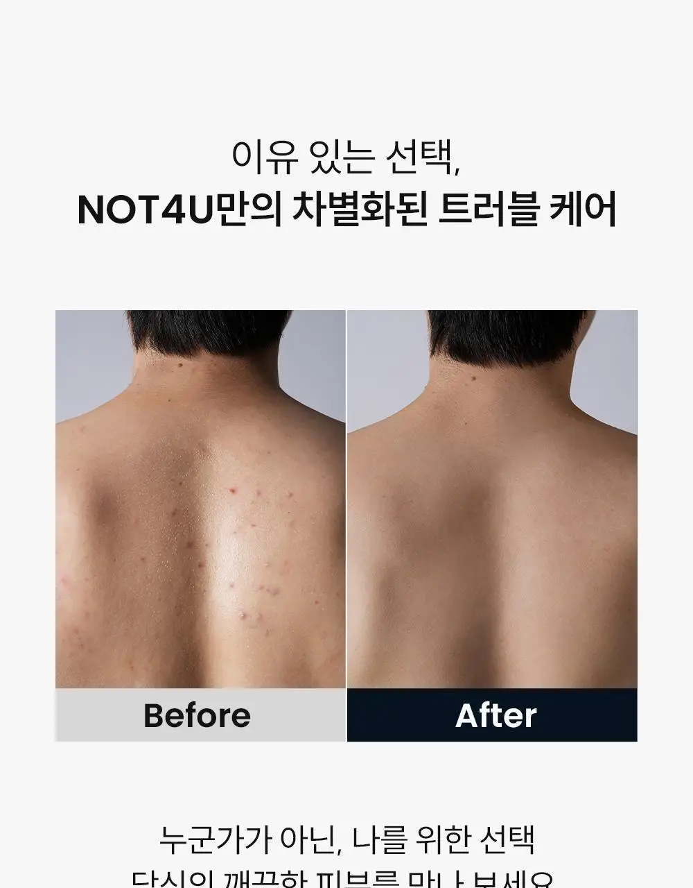 [등드름/체취케어] 낫포유 지성피부전용 등드름/가드름 클리어 올인원 바디워시 포맨 500ml 상세페이지 26